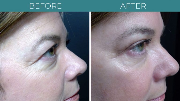 Blepharoplasty-BA_1