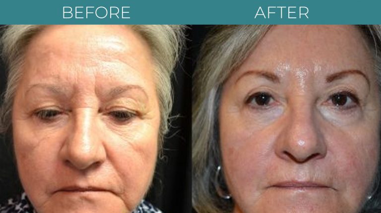 Blepharoplasty-BA_2