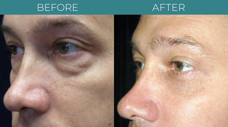 Blepharoplasty-BA_3