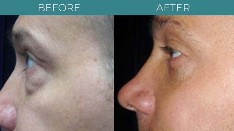 Blepharoplasty-BA_4