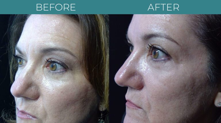Blepharoplasty-BA_9