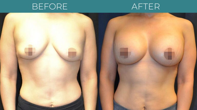 Breast Augmentation-BA_10