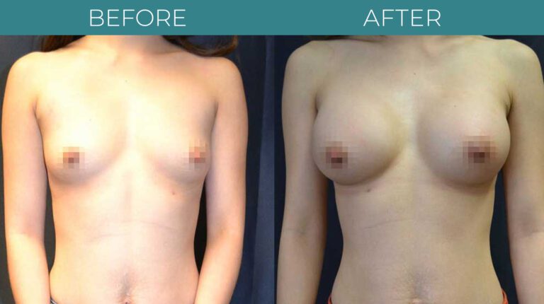 Breast Augmentation-BA_5