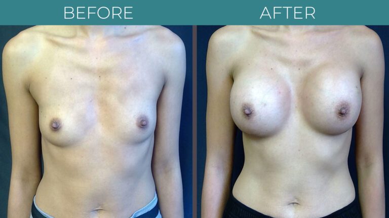 Breast Augmentation-BA_6