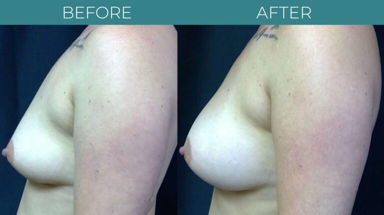 Breast Augmentation-BA_7