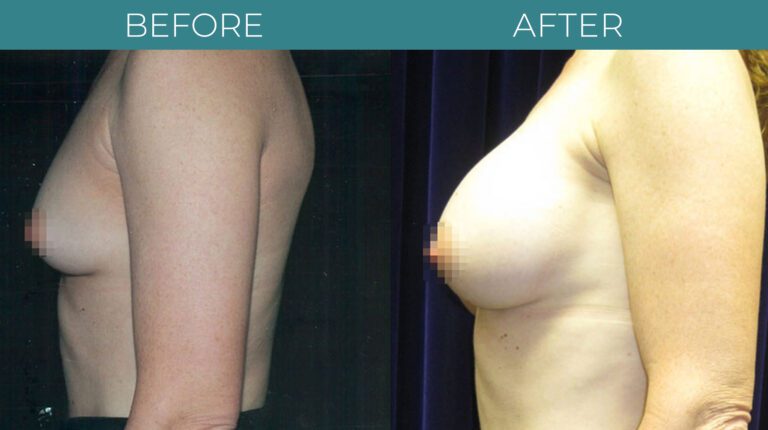 Breast Augmentation-BA_8