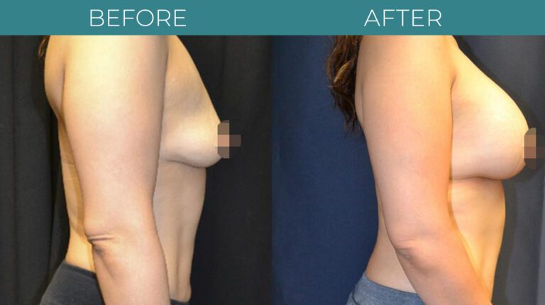 Breast Augmentation-BA_9