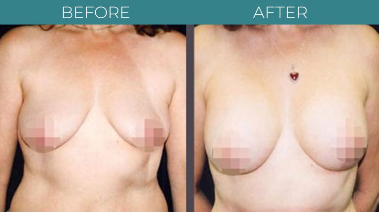 Breast Lift-BA_1