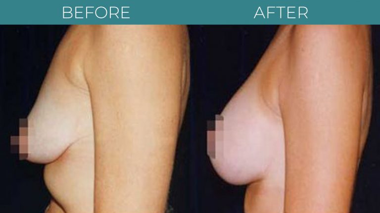 Breast Lift-BA_2
