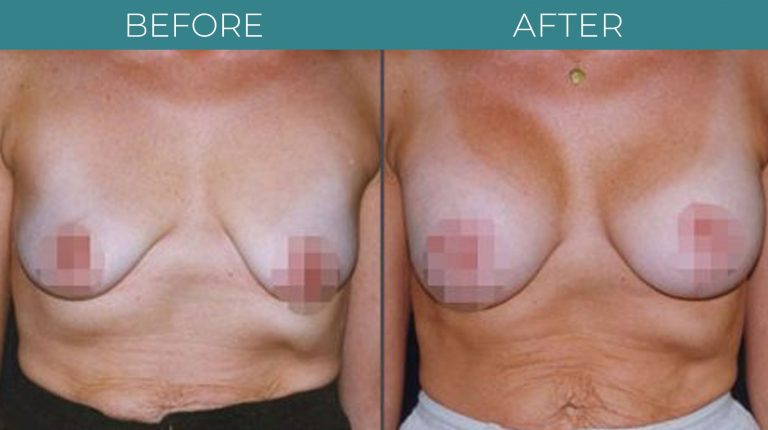 Breast Lift-BA_3