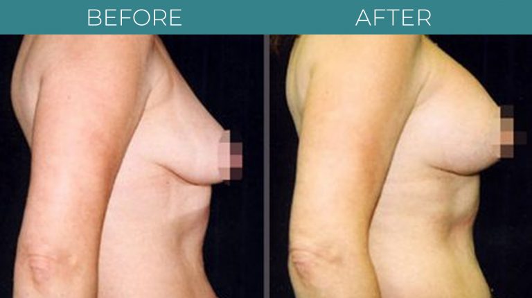 Breast Lift-BA_4