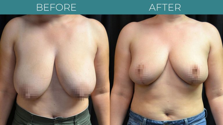 Breast Reduction-BA_1