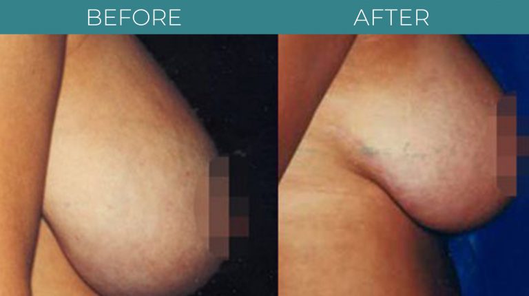 Breast Reduction-BA_3