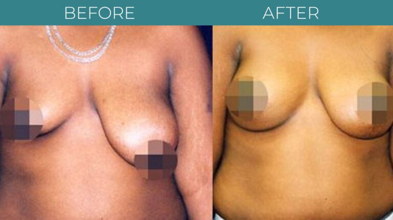 Breast Reduction-BA_4