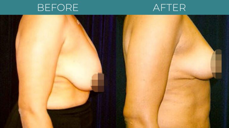 Breast Reduction-BA_5