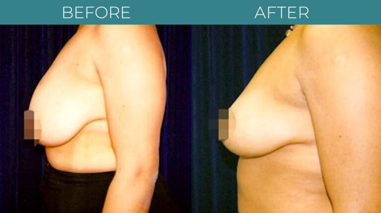 Breast Reduction-BA_6