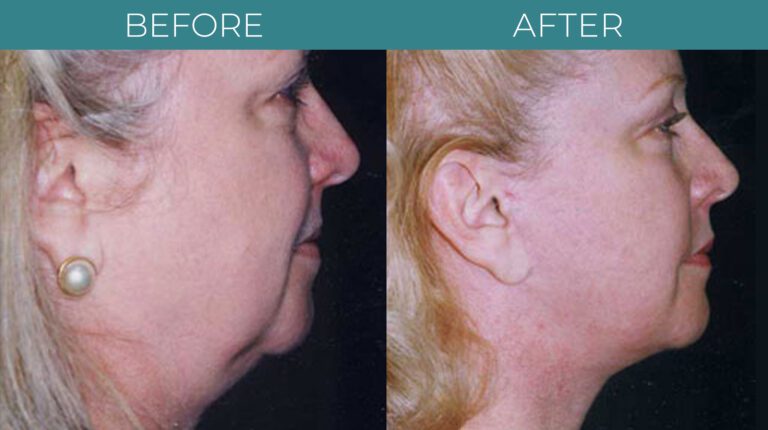 Facelift -BA_2