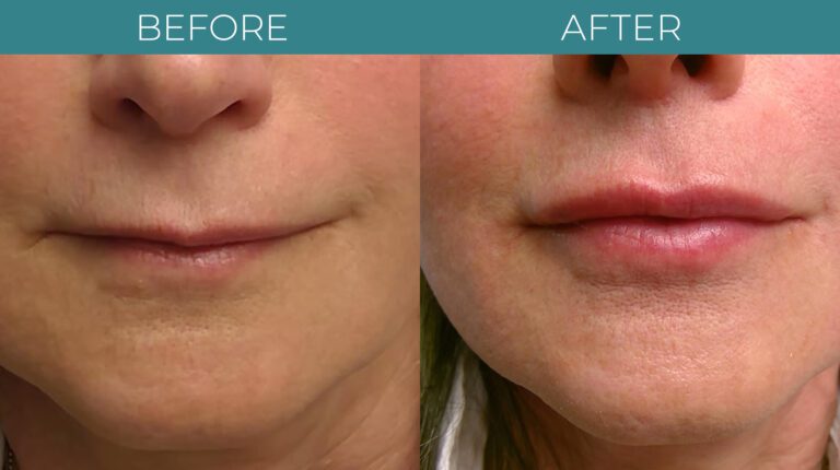 Facial+Lip Filler-BA_2