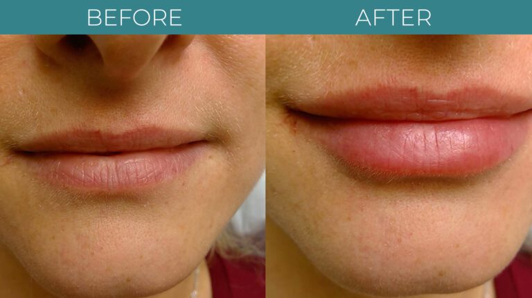Facial+Lip Filler-BA_3