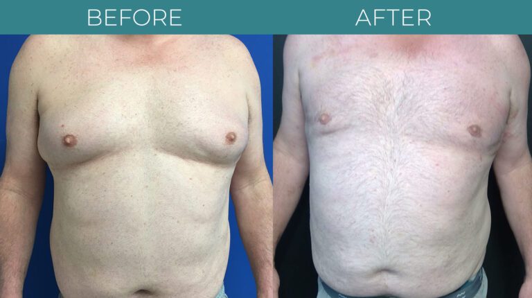 Gynecomastia-BA_5