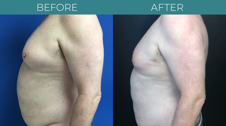 Gynecomastia-BA_7