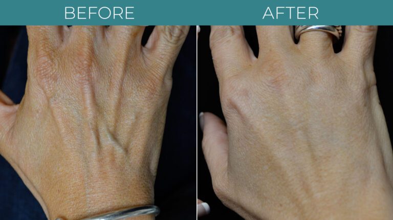 Hand-Rejuvenation-BA_2