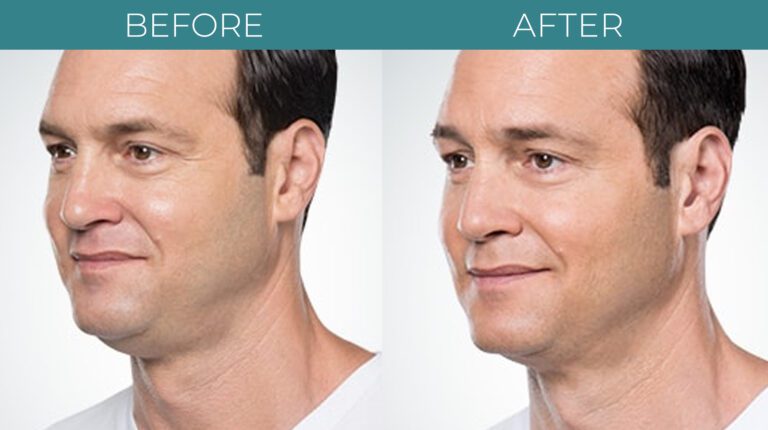 Kybella-BA_2