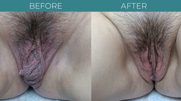 Labiaplasty-BA_3