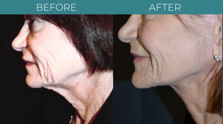 Necklift-BA_2
