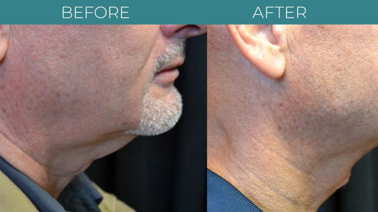 Necklift-BA_5