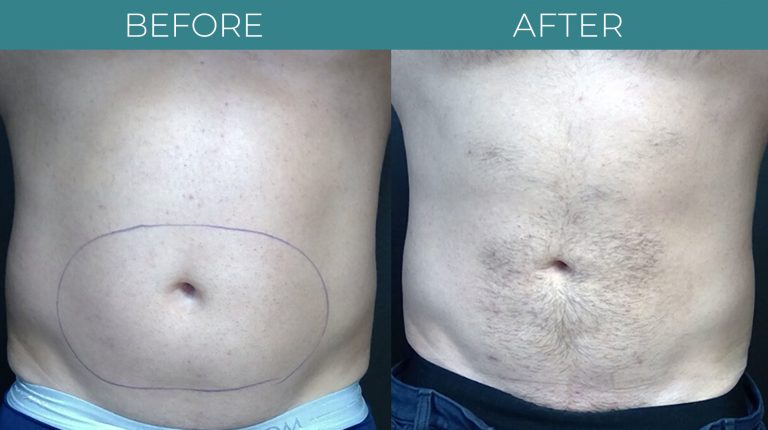 SmartLipo-BA_1