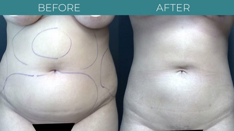 SmartLipo-BA_2