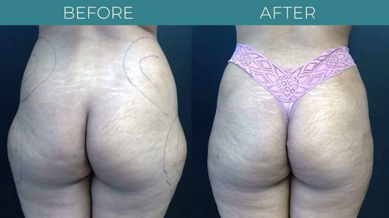 SmartLipo-BA_3