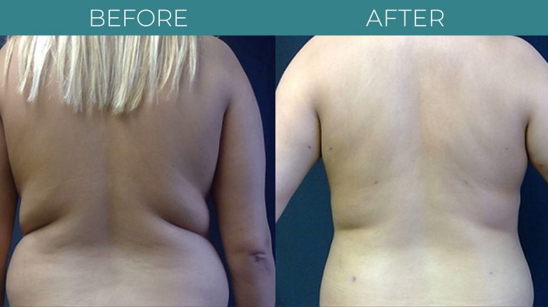 SmartLipo-BA_6