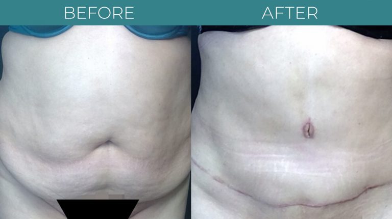 Tummy tuck-BA_1