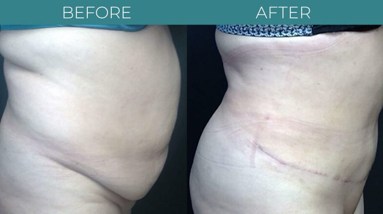 Tummy tuck-BA_2