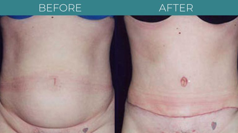 Tummy tuck-BA_4