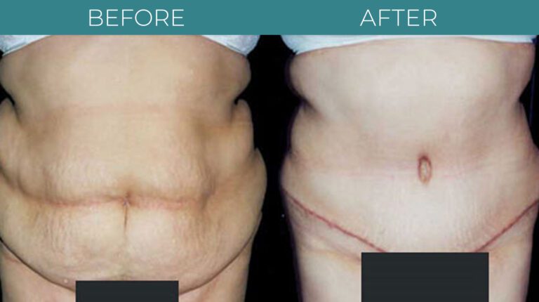 Tummy tuck-BA_7