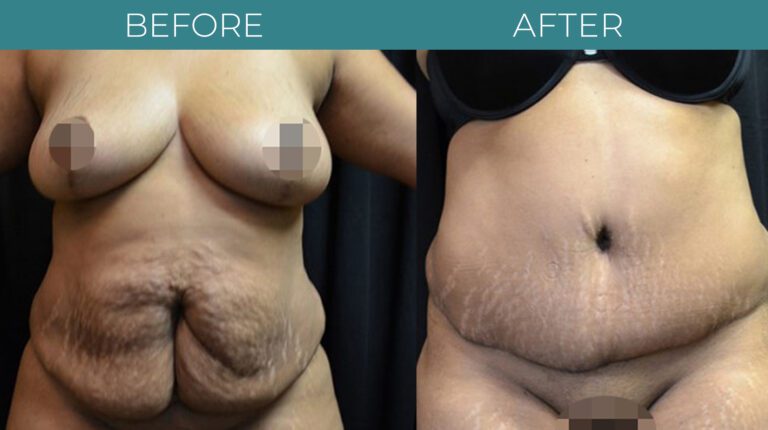 Tummy tuck-BA_9