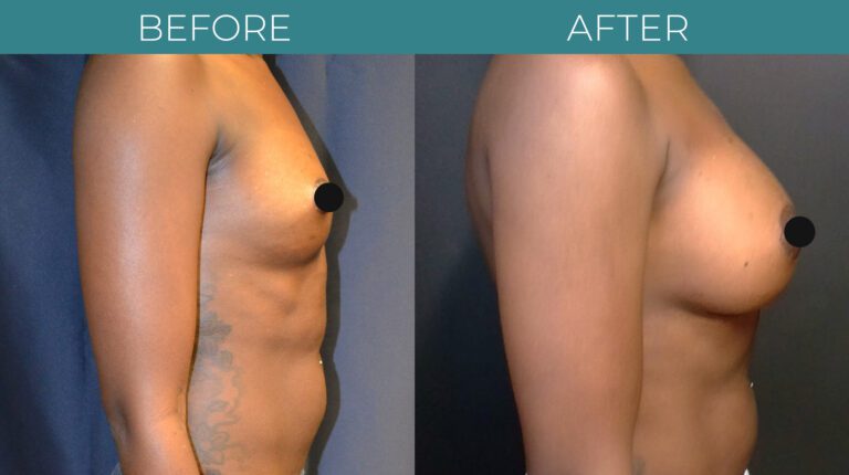 Breast Augmentation_10