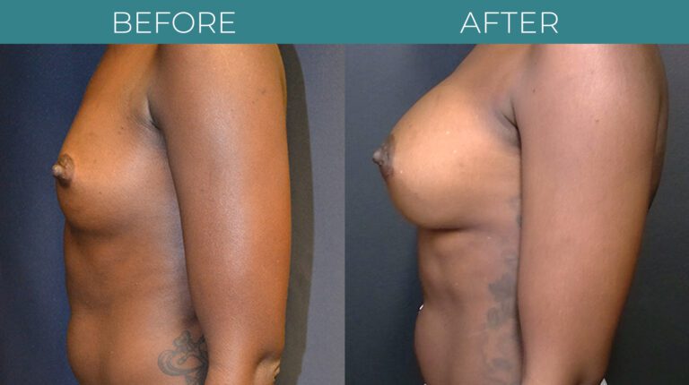 Breast Augmentation_5