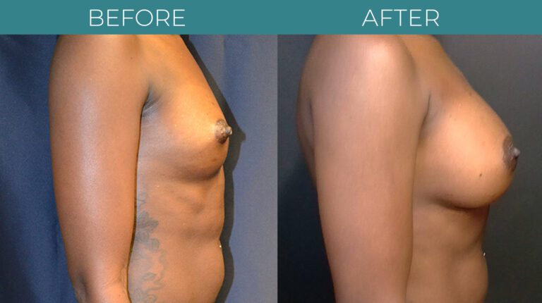 Breast Augmentation_6