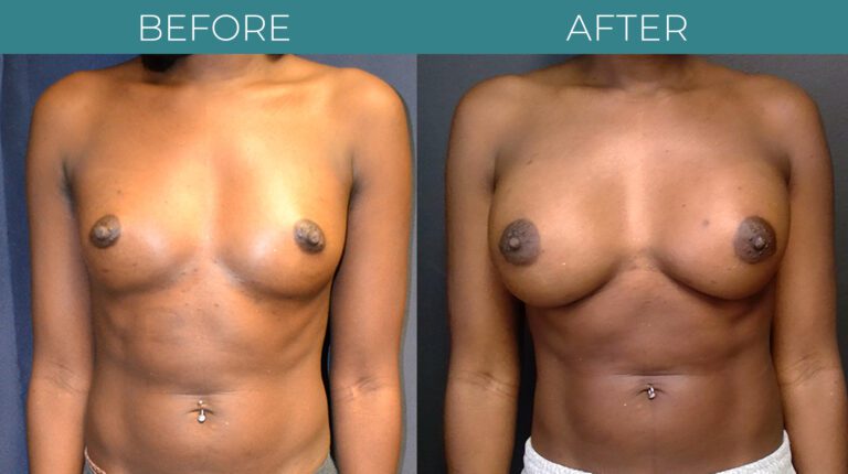 Breast Augmentation_7