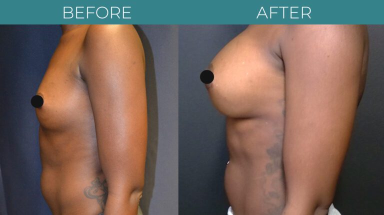 Breast Augmentation_8