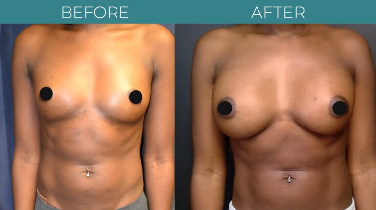 Breast Augmentation_9