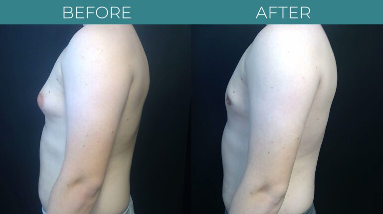 Gynecomastia_1