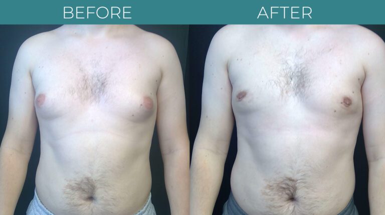 Gynecomastia_2