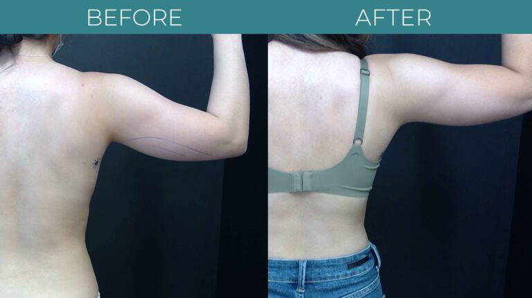Smart Lipo_7