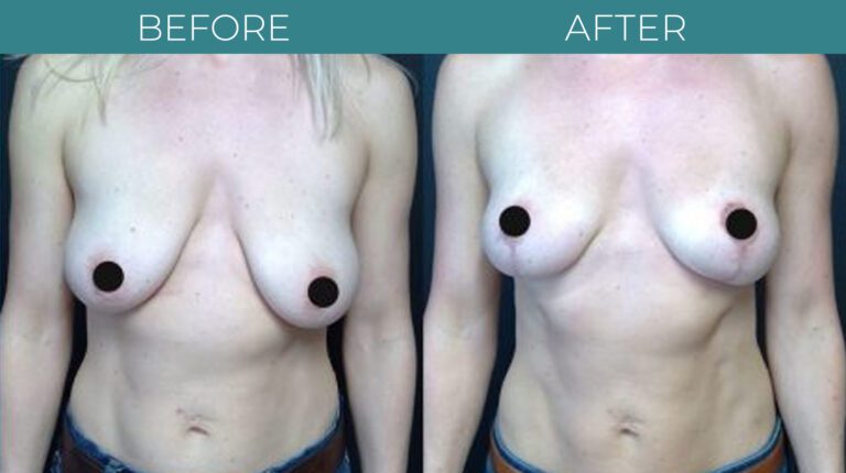 Breast Lift-BA_5