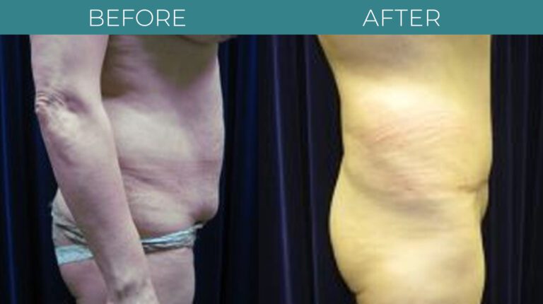 Tummy Tuck-BA_11